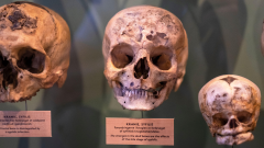 Syphilis Americas Diseases Study Skeletons Evidence